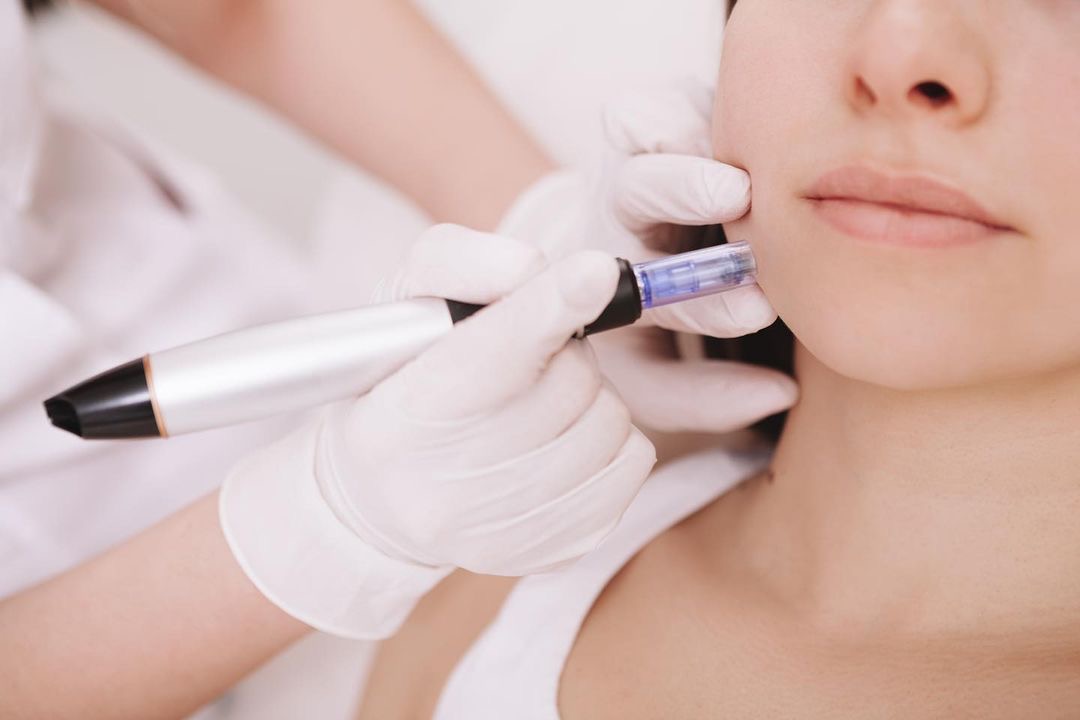 Dermapen: el aliado perfecto para una piel impecable